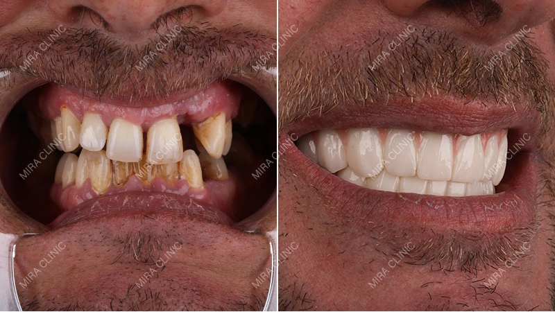 Dental Implants Before and After 